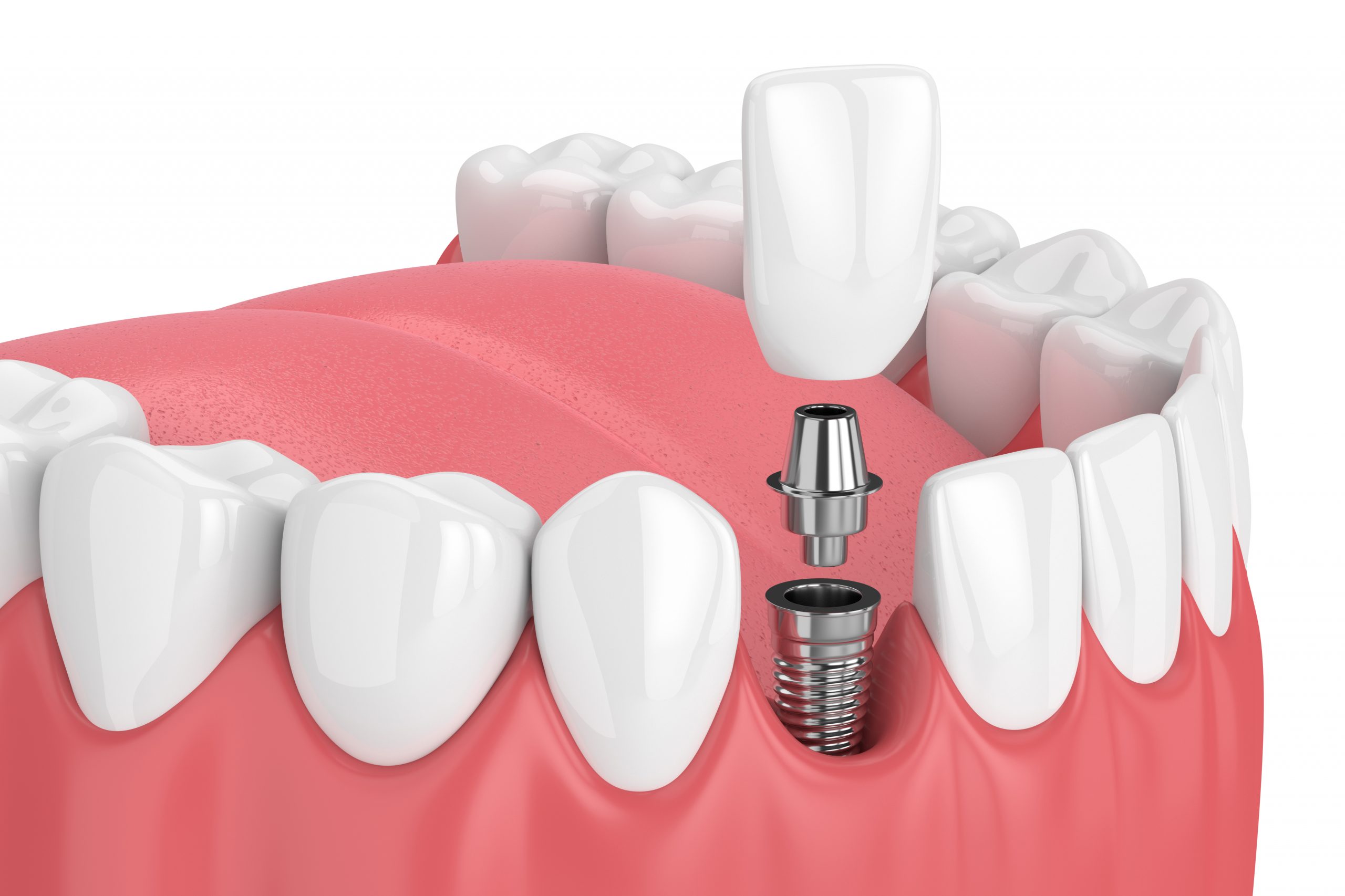 dental implant illustration