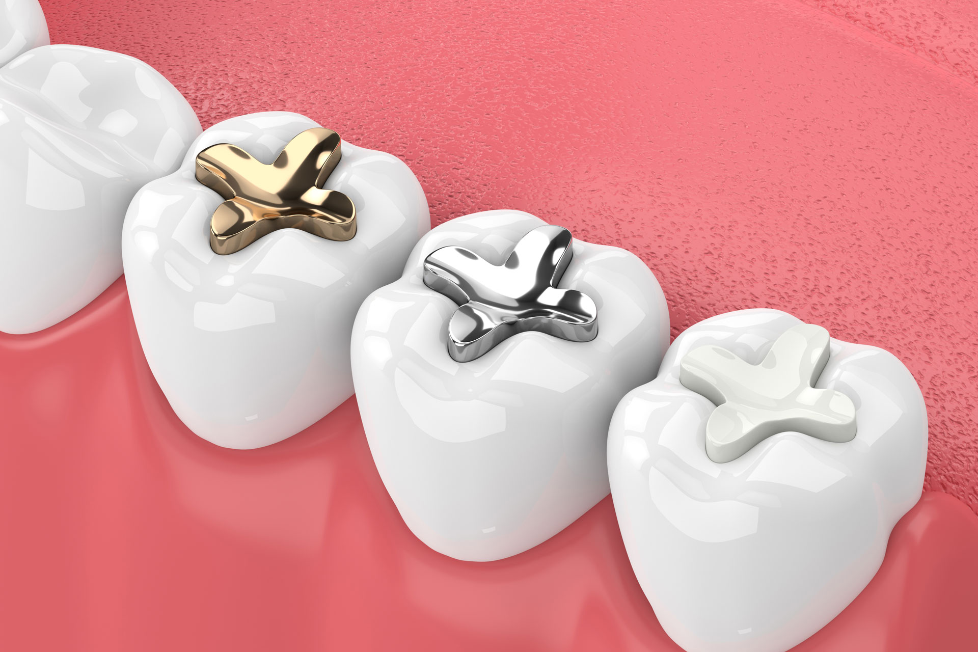 Dental Fillings In Phoenix Corner Dentistry