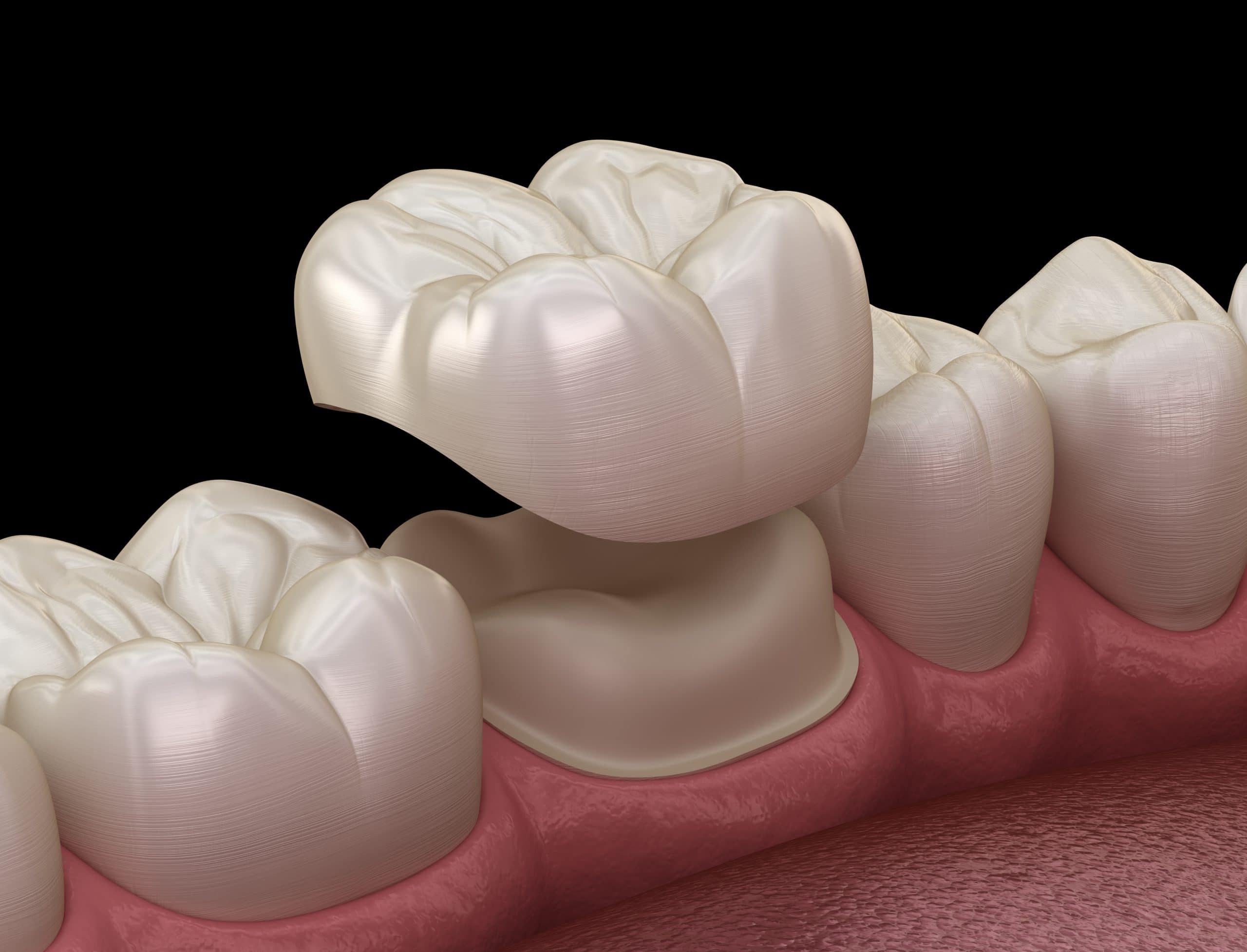 Everything You Need To Know About Dental Crowns For Front Teeth   Dental Crown Scaled 