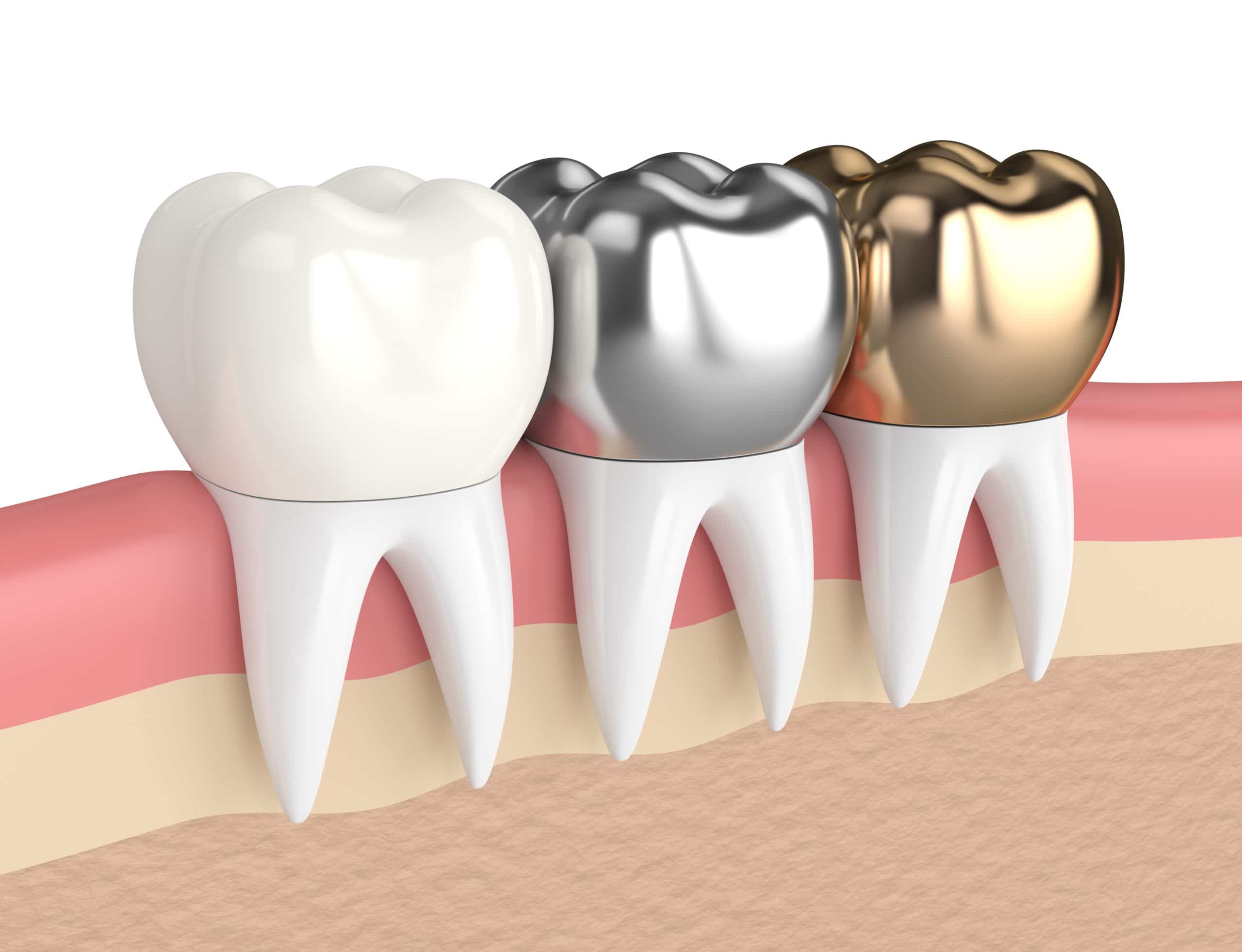 root canal metal crown