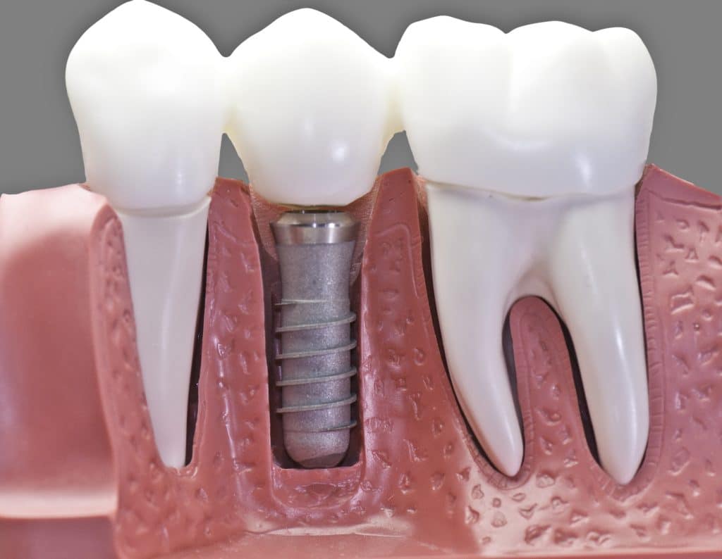 What Are The Four Types of Dental Implants? Which is Right for You?