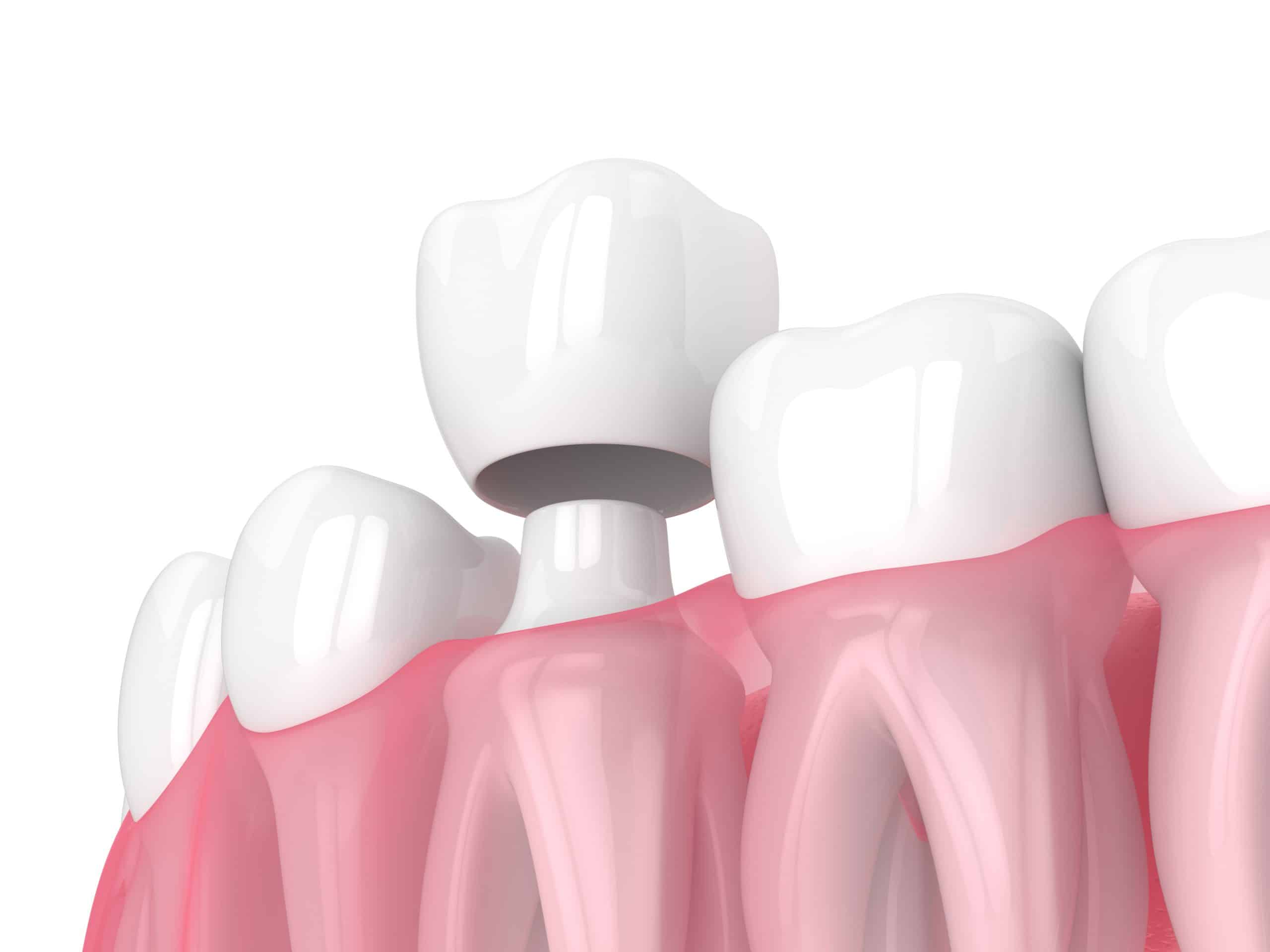 Five Benefits of Choosing CEREC Crowns Over Traditional Crowns