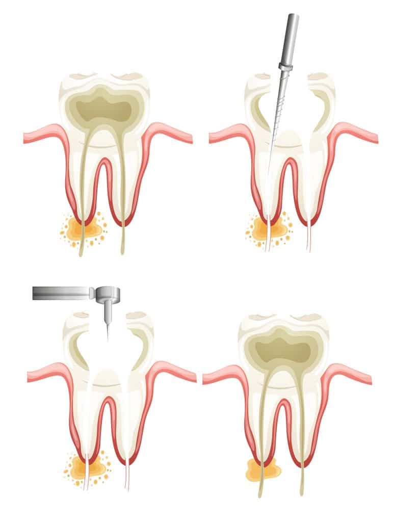 how long does a root canal take to heal