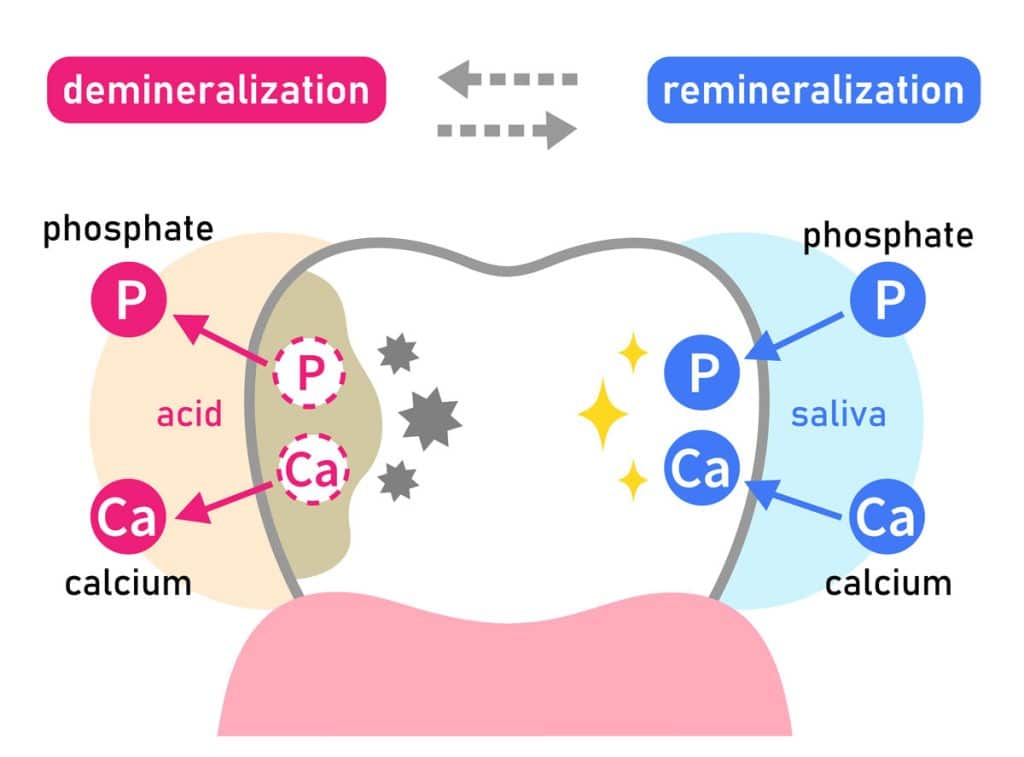 remineralization