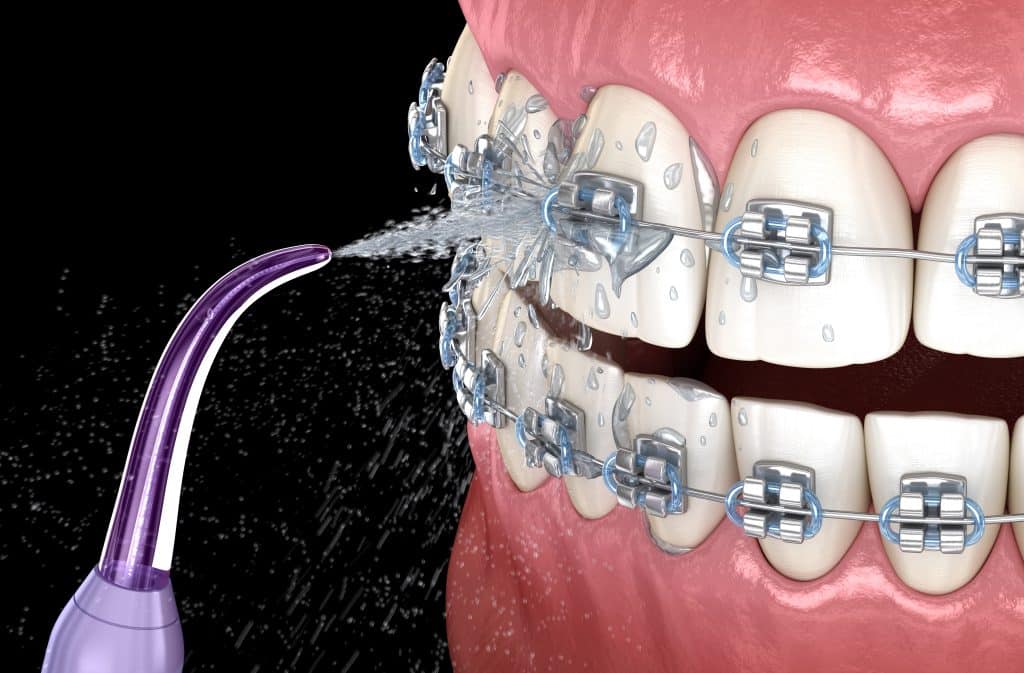 Is Water Flossing Effective? Pros and Cons Versus Regular Flossing