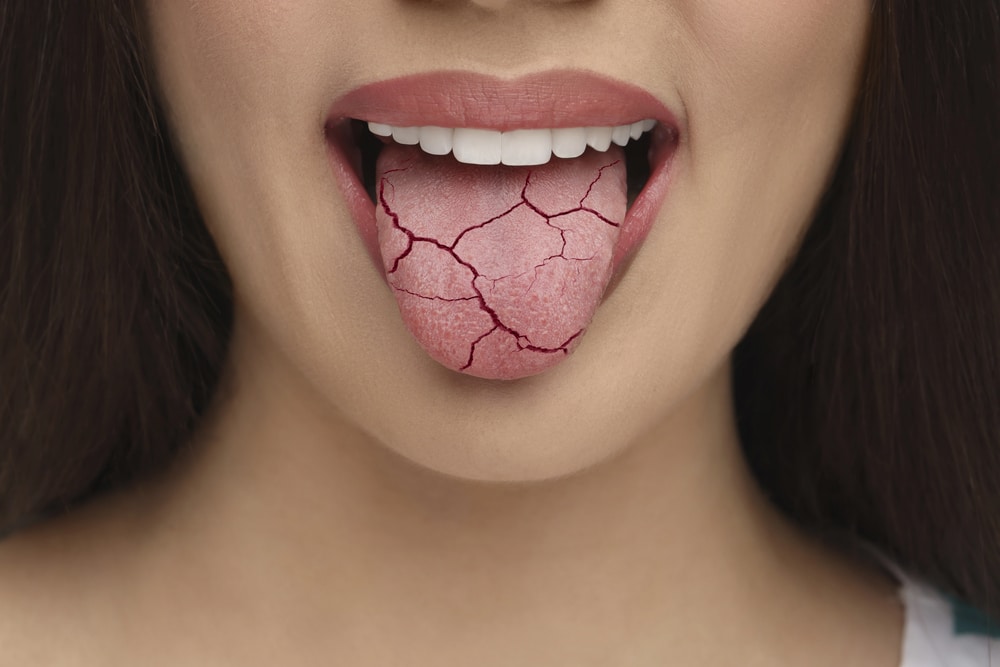 Why Is My Mouth So Dry? Causes & Effects on Teeth